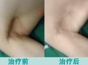 狐臭手术