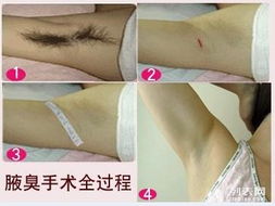 成都哪家医院治疗狐臭效果好