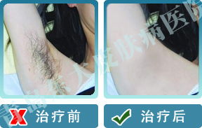 轻度腋臭怎么治疗